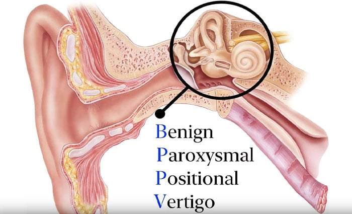 What Is Benign Paroxysmal Positional Vertigo Maneuver